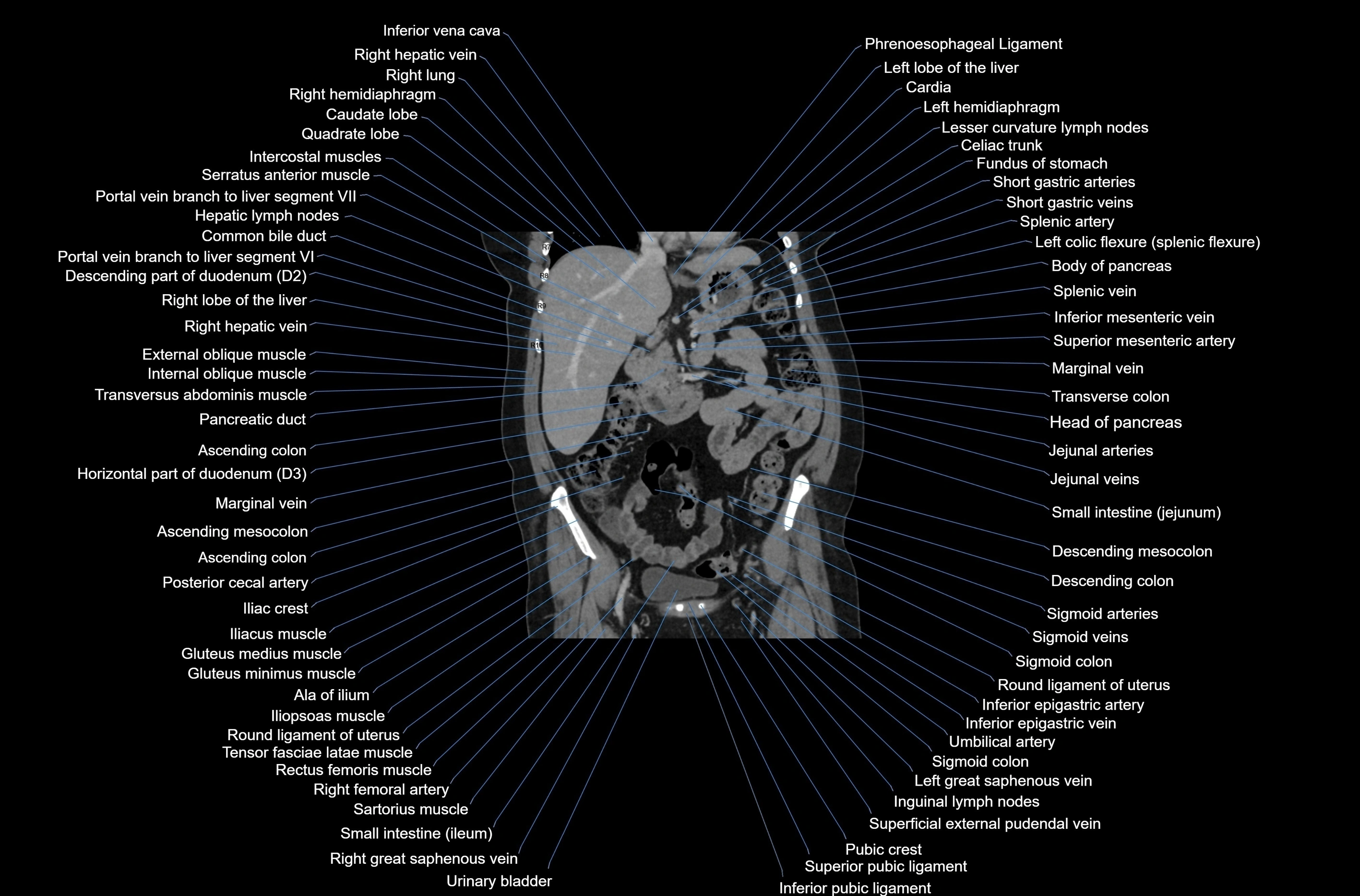 CT abdomen coronal cross sectional anatomy labelled radiology image-00039.webp